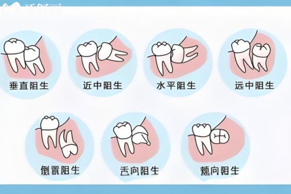 深圳拔一颗智齿需要多少钱？