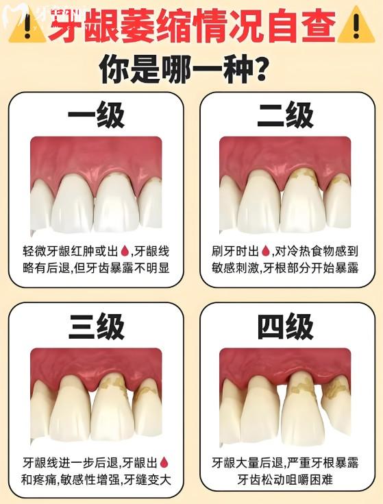 牙龈萎缩怎么治疗比较好