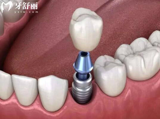杭州口腔医院收费高吗?不贵,2025年种植牙价格2000元起