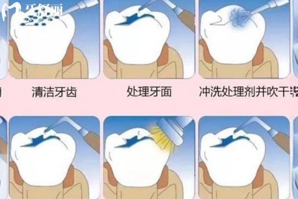 纳米树脂补牙值不值得做