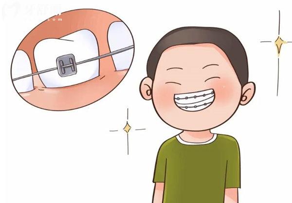 沈阳牙齿矫正价格全攻略