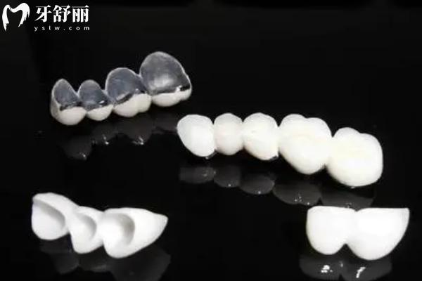烤瓷牙多少钱一颗价格表2025