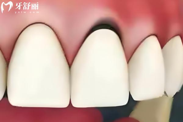 烤瓷牙多少钱一颗价格表2025