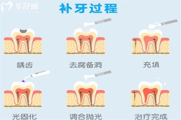 怎么判断补牙是否成功了?关注补牙后这些注意事项及细节即可判断!