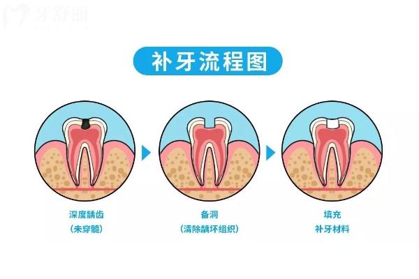 补牙齿一般要多少钱一颗？具体看材料看医生资质看地区看医院