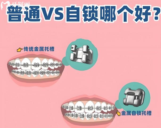自锁VS非自锁托槽哪个好