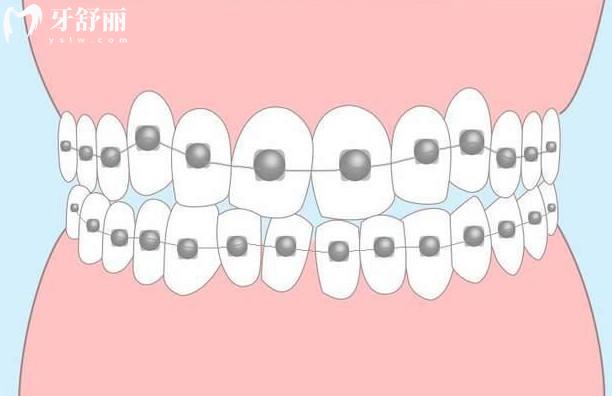 自锁托槽与非自锁托槽的区别