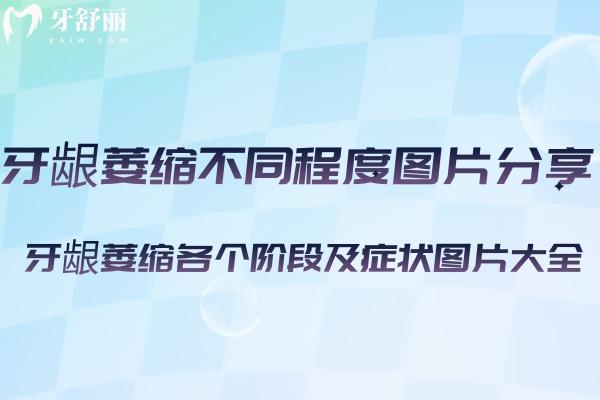 牙龈萎缩不同程度图片