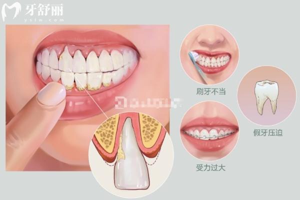 牙龈萎缩不同程度图片