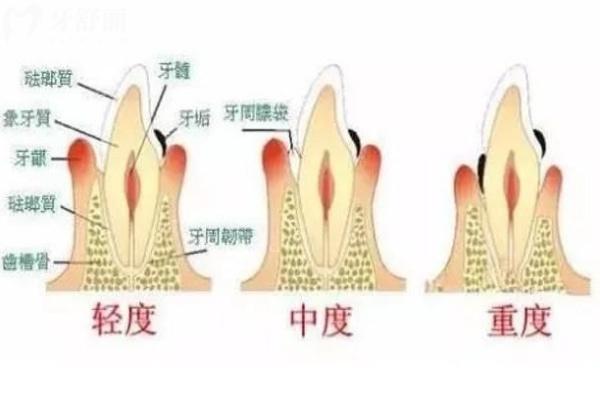 牙龈萎缩不同程度图片