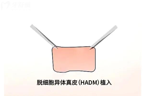 李世荣做生物补片增粗行吗