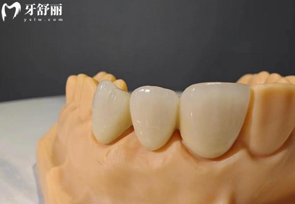义佳微纳熔覆义齿是什么材料