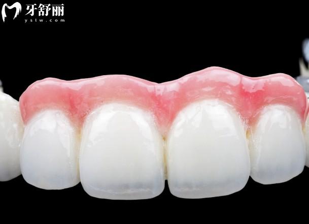 3d打印假牙比传统假牙好吗