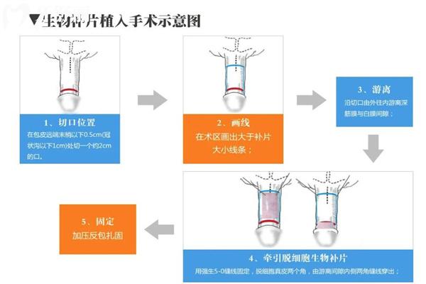 生物补片增粗可靠吗?通过术后<span style=