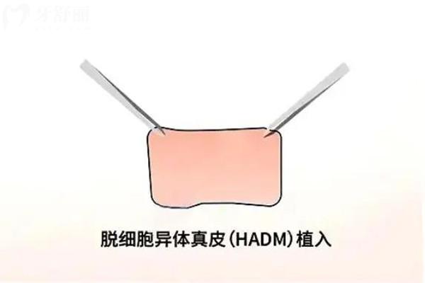 生物补片增粗靠谱吗