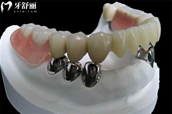 吸附性义齿与普通义齿区别图片对比:固定方式/舒适度/使用寿命/价格差一览可知