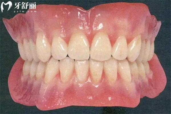 吸附性义齿与普通义齿区别图片对比:固定方式/舒适度/使用寿命/价格差一览可知