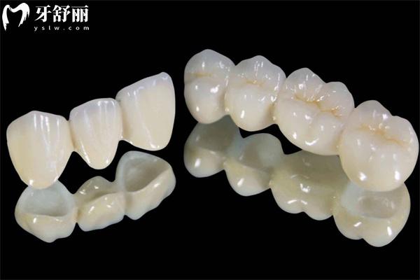 一颗牙齿牙套多少钱 三大牙冠种类及价格表显示金属牙500+陶瓷牙800+全瓷牙1200+