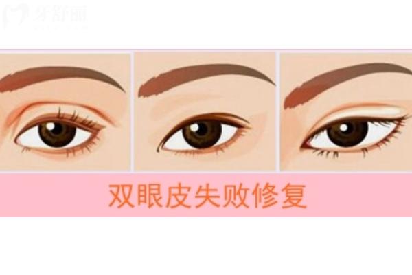 师丽丽双眼皮修复<span style=