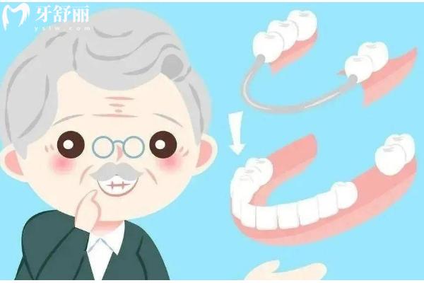 活动义齿的种类和材料有哪些？种类与材料的口腔修复新手指南