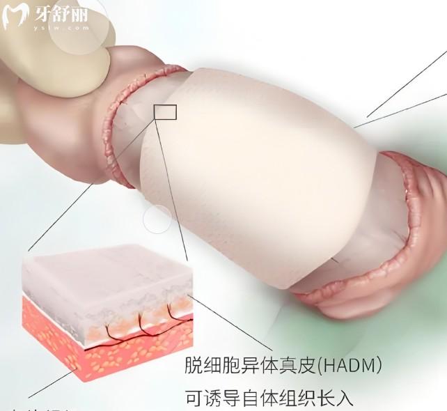 生物补片如何实现增粗与修复