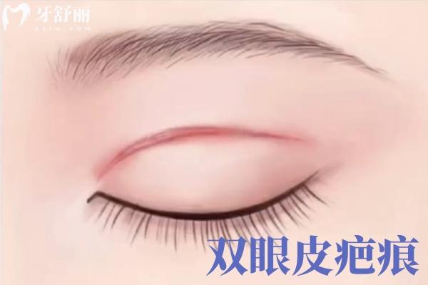 北京丰联丽格师丽丽双眼皮修复价位