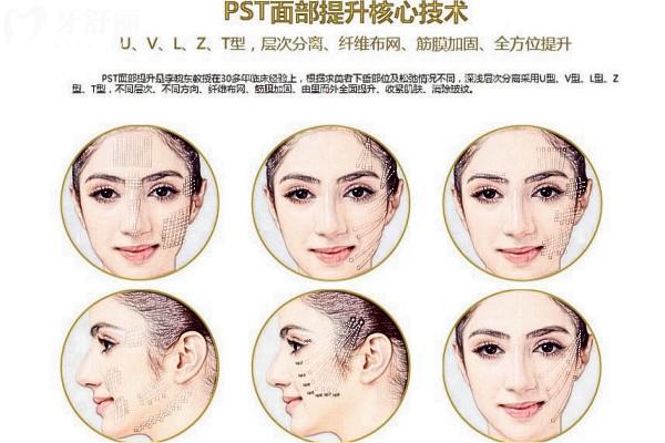 北京黄寺整形医院拉皮全脸多少钱?价格表显示3w-26w不等可玉杜太超/李晓东