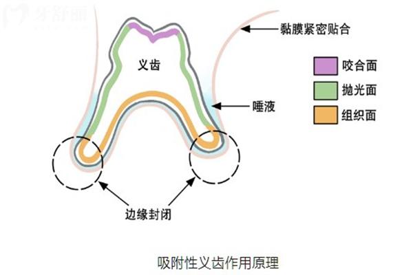 吸附式假牙的优点和缺点是什么?究竟值不值得选?带你解析详细优缺点与选择指南