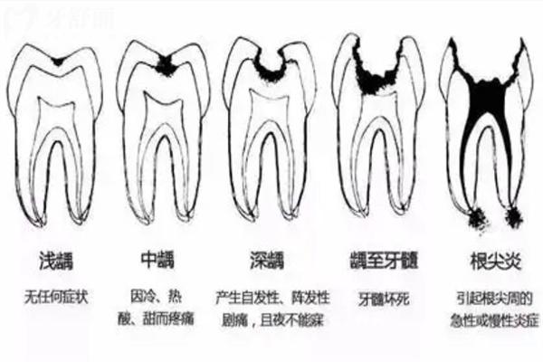 怎么判断龋齿龋坏程度?龋齿一度到五度图片照片大全真实分享