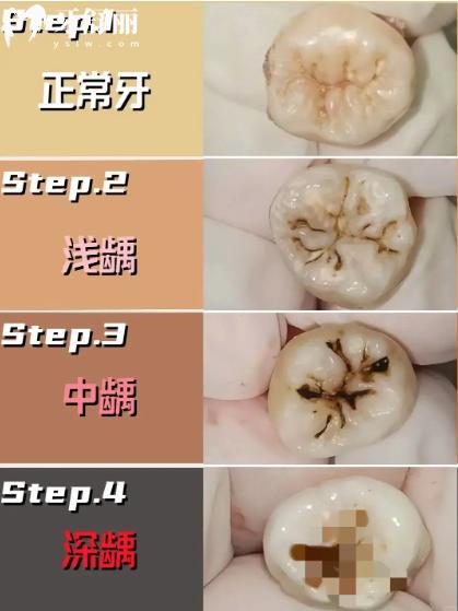 怎么判断龋齿龋坏程度?龋齿一度到五度图片照片大全真实分享