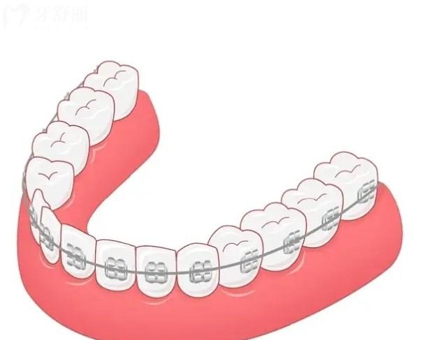 奥美科矫正器有几款型号