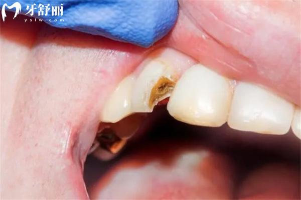 门牙磕掉一小块怎么补?门牙缺损不同程度的修复方法有哪些快来了解!