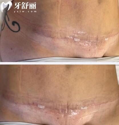 成都西区整形医院李虹怎么样?腹部整形口碑好：正规资质+20年经验+成功实例多