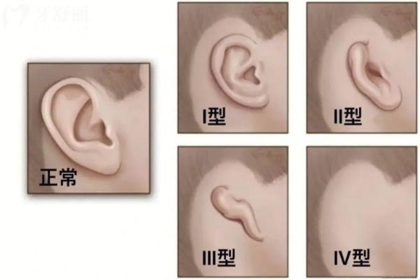广州高尚医学美容中心做耳畸形手术好吗?查询余文林做耳朵再造修复技术口碑便知