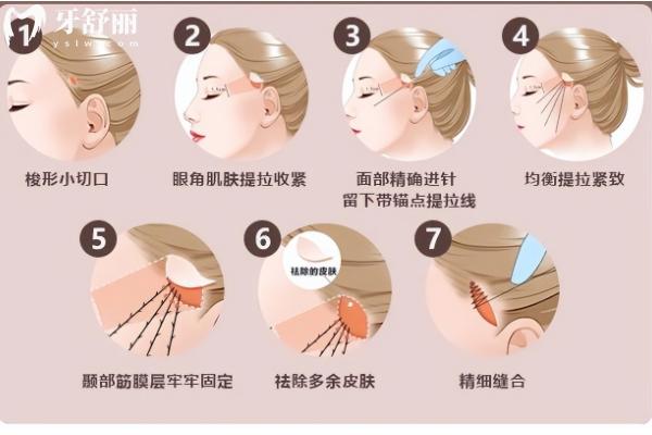 李建钢筋膜提升真的有用吗