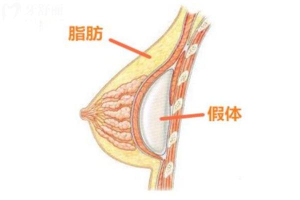 广州朱云医生筋膜层丰胸怎么样