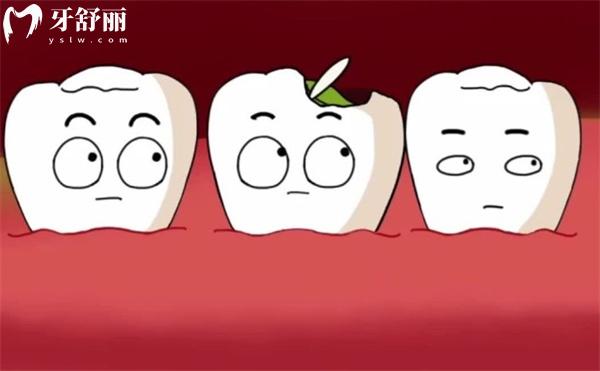 陶瓷嵌体补牙好不好?和树脂嵌体补牙哪个好?3分钟带你来揭秘