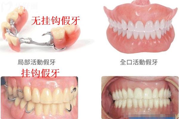 装半口假牙有几种方法?活动牙/固定牙究竟哪种好对比材料及价格表来看看吧