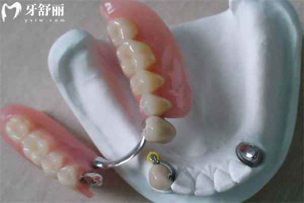 装半口假牙有几种方法?活动牙/固定牙究竟哪种好对比材料及价格表来看看吧