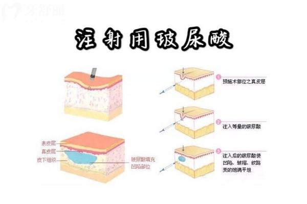 韩国打玻尿酸多少钱一支