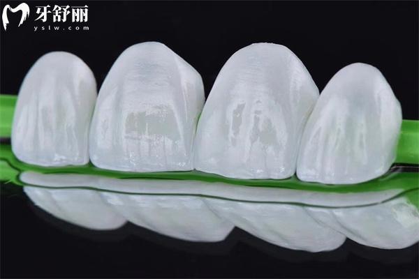 全瓷牙贴面大概多少钱?单颗