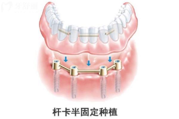 海南种植牙价格表在线查询