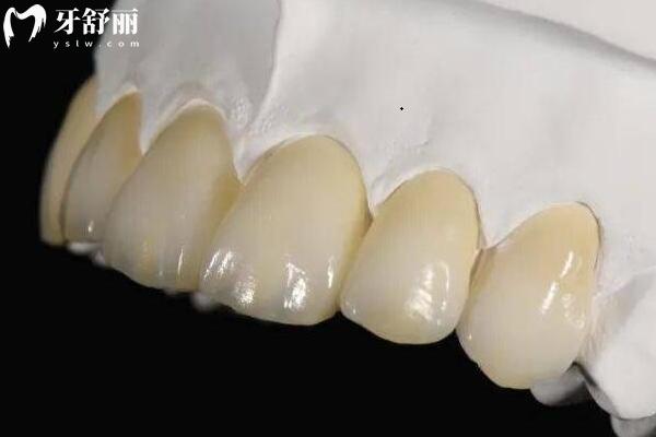 烤瓷牙分为哪几类类型？金属烤瓷牙/全瓷牙/贵金属烤瓷牙优缺点分享
