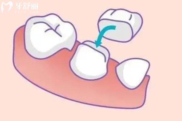 牙齿间隔缝隙大怎么办？常见五种原因+解决方法奉上