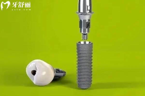 ITI种植体三种型号怎么选？