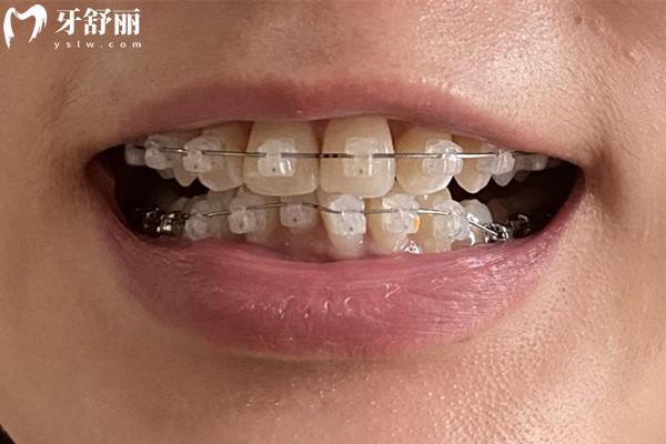 乐山口腔医院矫正牙齿多少钱