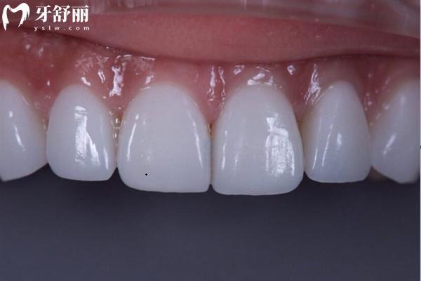 东莞牙状 元口腔收费标准查询，补牙145+拔智齿610+种植牙2080+附地址