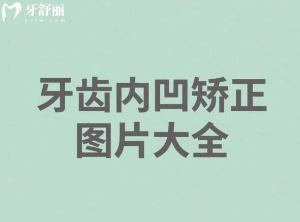 牙齿内凹矫正图片大全