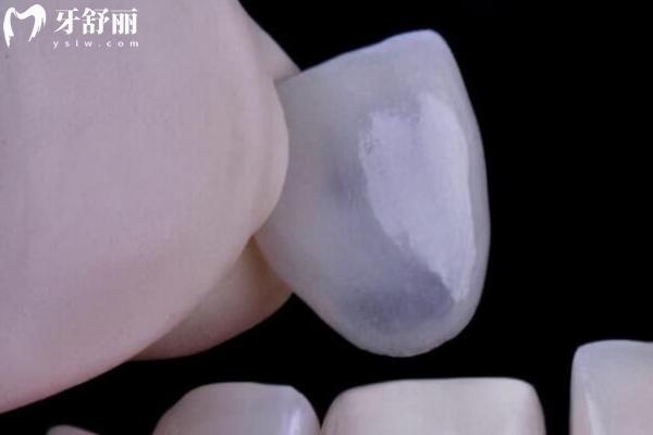 牙齿贴面分为哪几种材料？树脂贴面/瓷贴面/超瓷贴面/美容冠贴面优缺点分享