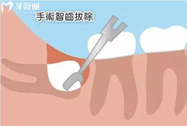杭州拔智齿收费价目表